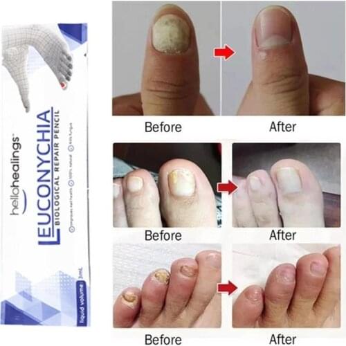 3ml Effective Skin Tags Moles Remover Pen Remover Foot Corn Wart Dark Spot Genital Onychomycosis Nail Medical Repair Care Liquid