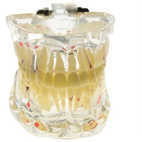 Promotion Dental Study Tooth Transparent Adult Pathological Teeth Model Dental Lab Equipment Dentist Teaching