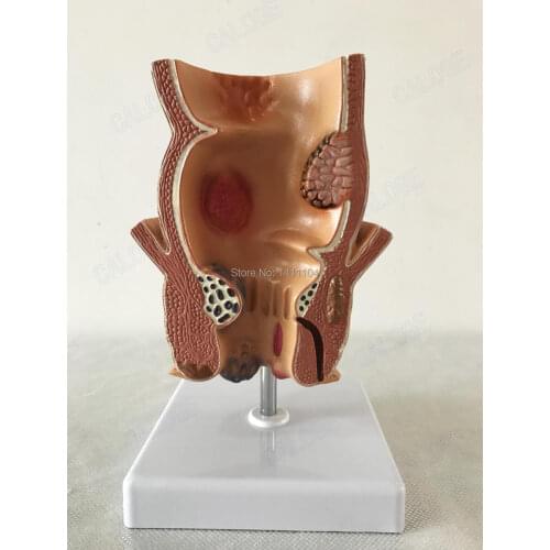 Free shipping&Rectal pathological model,Ulcerative colitis,Hemorrhoids demonstration model,Teaching for medical