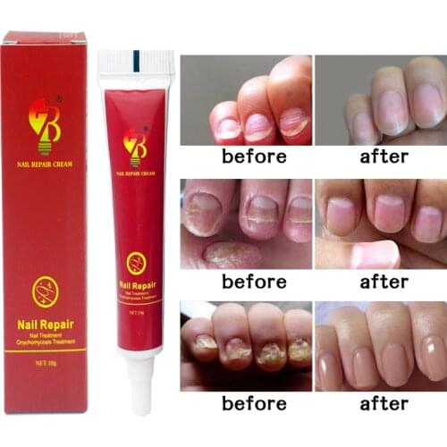 Nail Treatment ointment Treatment Onychomycosis Paronychia Anti Nail Infection Nail treatment Plaster