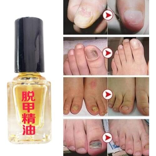Foot hand Nail Bright Repair Treatment Nail Oil Anti Fungus Infection