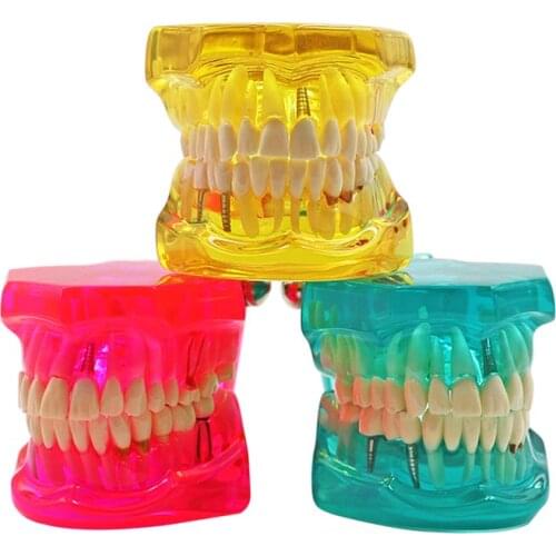 Oral Teeth Teaching Model Dental Teeth Disease Implantation Model Dentist Tools Tooth Model Detachable Training Tools Equipment