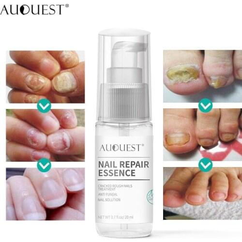 New Fungal Nail Treatment Feet Care Essence Gel Whitening Toe Fungus Removal Anti Infection Paronychia Onychomycosis