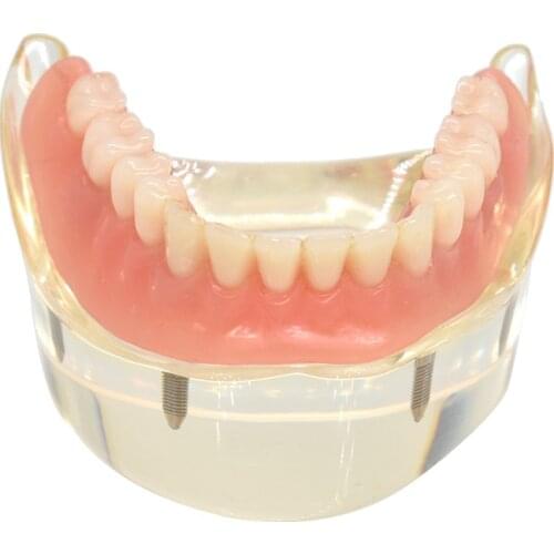 Dental Overdenture Teeth Model Removable Mandibular Lower Teeth Model with 4pc Implant screws Implant Restoration Model Teaching
