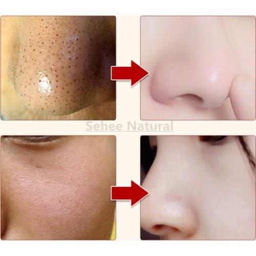 Chinese Herbal Acne Cream Acne Print Removing Whiten Freckle Day Cream 1000g 1kg Beauty Salon Equipment