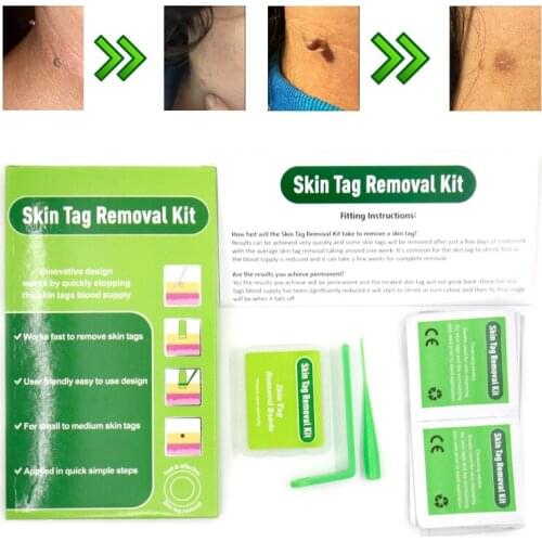Micro skin tags removal kit quick sticker to remove warts body skin care tools face Skin Tag Removal patch Acne Tag Remover band