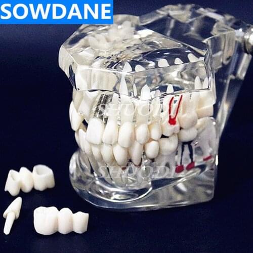 Dental Disease Teeth Model With Restoration Bridge Tooth Dentist For Medical Science Dental Disease Teaching Study