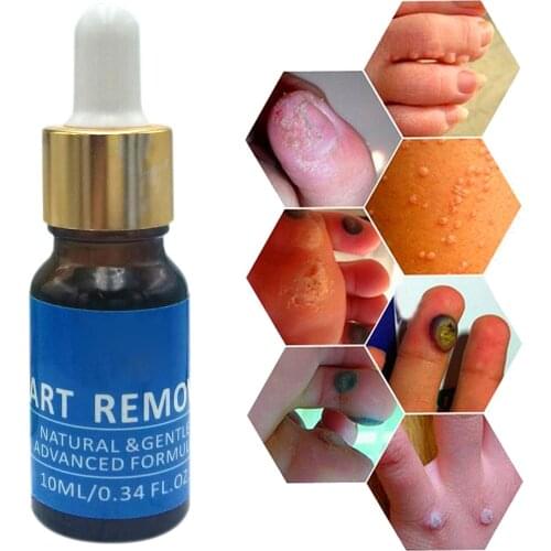 Body Fungal Treatment Anti Infection Nourishing Care Premium Wart Remover Liquid