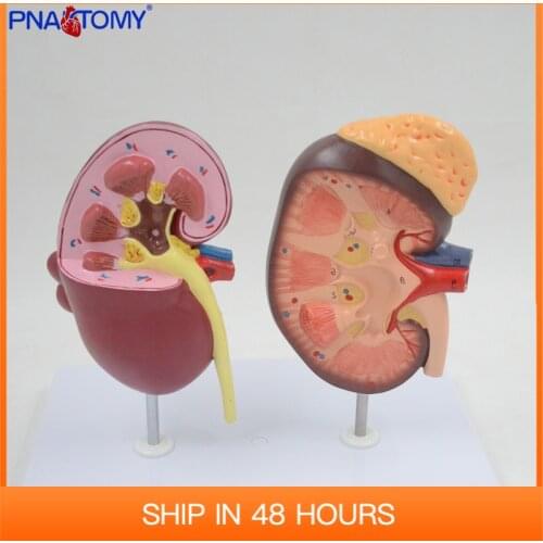 Normal and Diseased Kidney Model Urinary System Renal Anatomy Medical Teaching Tool Educational Equipment