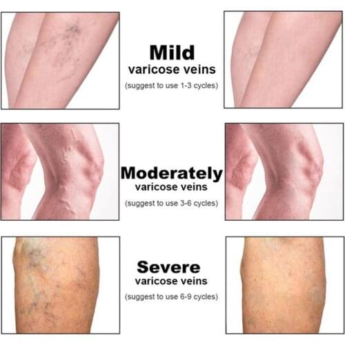 Pain Relief Varicose Veins Cream Herbal Analgesic Plaster Angiitis Varicosity Phlebitis Spider Remedy Leg Ointment F6C9