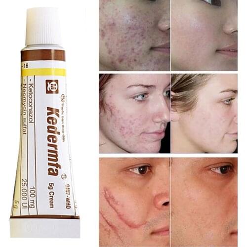 Professional Vietnam Snake Oil Ointment Remove Scar Cream Acne Treatment Hand Skin Face Care Natural 5g Snake Ointment