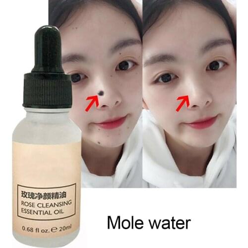 20ml Spots Removal Solution Painless Face Freckle Mole Wart Treatment Liquid