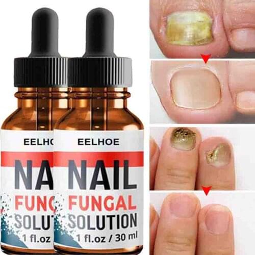 Fungal-nail Treatment Serum Onychomycosis Paronychia Nail Repair Serum Massage Anti Fungal Nail Infection Nail Care 10/20/30ml