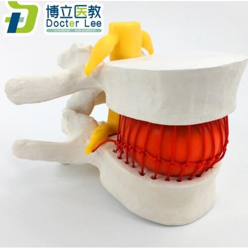 Plastic Human anatomy skeleton spine model with nerve Disc herniation medical science teaching tool