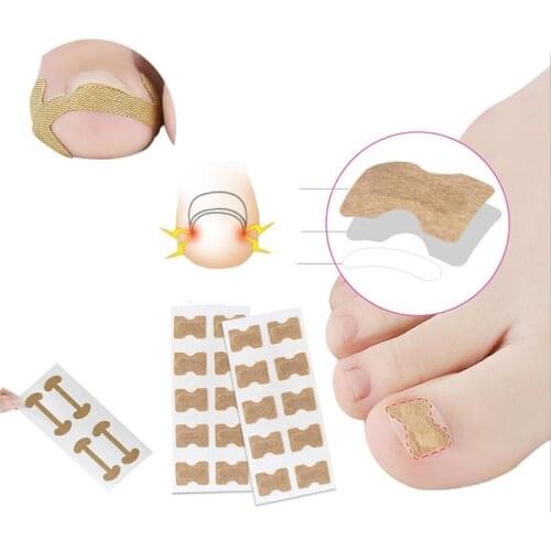1Set Ingrown Toenail Corrector Sticker Paronychia Treatment Corrector Pedicure Foot Orthodontic Toe Thumb Nail Care Patches