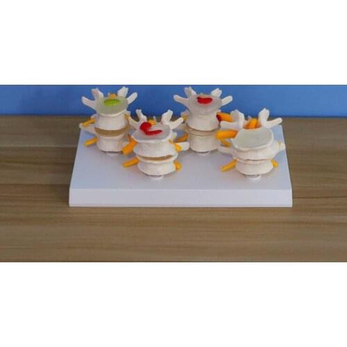Quadrilateral lumbar spine model normal and disease combined lumbar skeleton model medical teaching