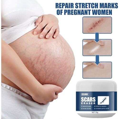 Pigmentation Scar Removal Cream Skin Care Maternity Body Healing Stretch Marks Spots Acne Treatment Burns Scald 30g Pregnancy