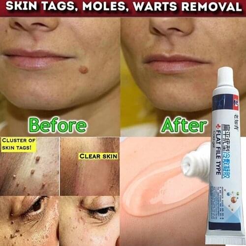 Skin Tag Remover 12 hours Medical fast Removal Mole & Genital Wart Foot Corn Treatment Kit skin Care Anti Wart Bacteriostatic