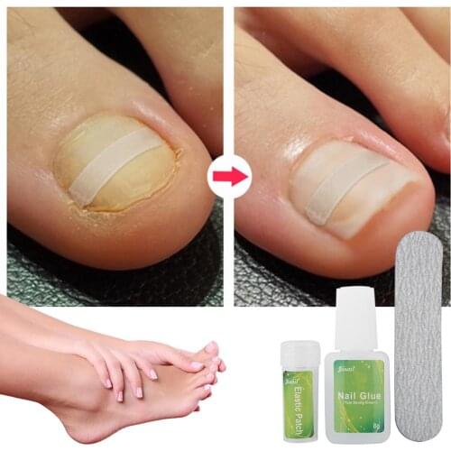 12pcs/24pcs Ingrown Elastic Toenail Patch Correction Tool Glue Foot Toe Nail Treatment Pedicure Sticker Straightening Clip Brace