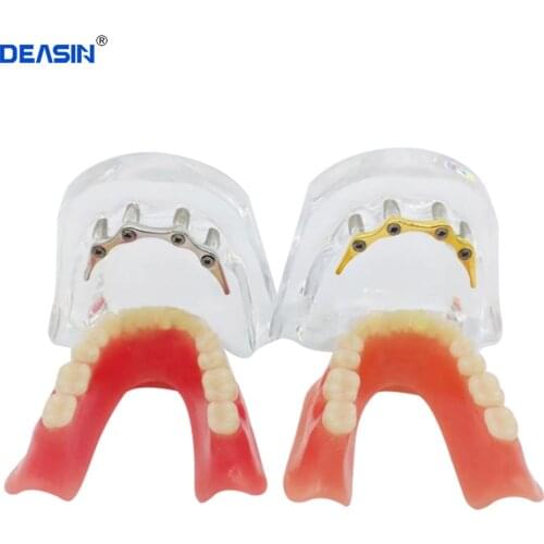 Repair teeth implant model with golden bar Denture Teeth mandibular model Dental Teaching Model