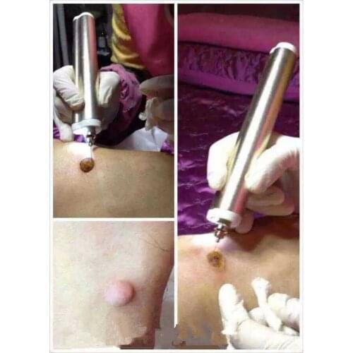 Rechargeable Micro Plasma Spot Removal Pen Electric Mole Speckle Nevus Remover Cautery Beauty Tool