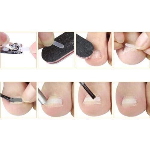 Professional Strong Ingrown Toenail Set with Toenail Braces Long-Lasting Tools for Nail Correction Correct Toes Home Use Salon