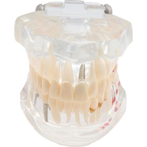 Dental Teeth Model Implant Study Analysis Demonstration Disease Restoration Implant Disease Teeth Model With Restoration Bridge