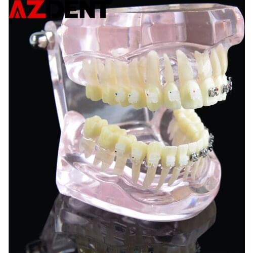 Dental Orthodontic Model Teeth Implant Restoration Bridge Teaching Study For Dentist Medical Science