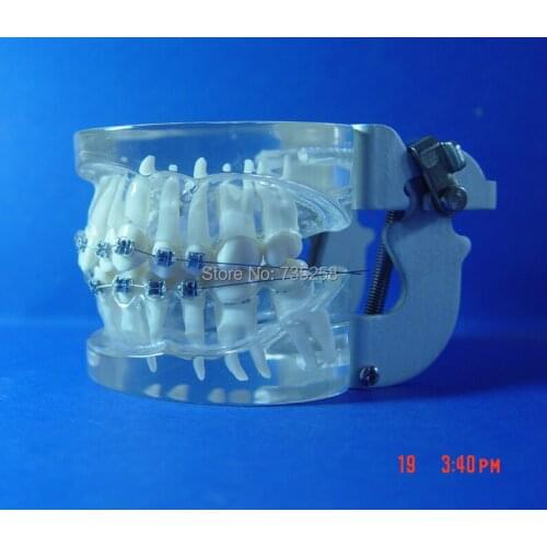 Teeth Orthodontic Model,Metal Braces Teeth Wrong Jaws Model Demonstration,Tooth Orthodontic Training Model