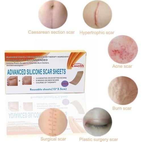 Scar Removal Sheet For Stretch Marks Wound Patch Therapy Acne Sticker Repair Skin Silicone Treatment Care Skin Reusable Was S0A8