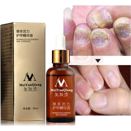 Nail Fungal Treatment Feet Care Essence Nail Foot Whitening Toe Nail Fungus Removal Gel Anti Infection Paronychia Onychomycosis