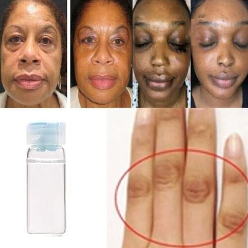 Corrective skin-lightening cream for hyperpigmentation for hands and feet