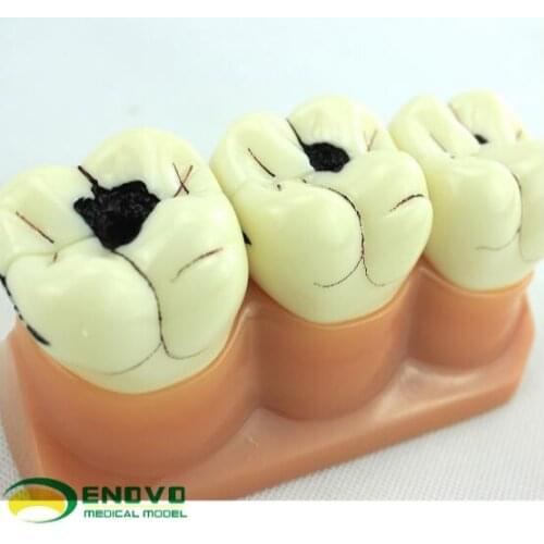 Dental caries decomposition model dental pathologic dental caries model doctor-patient communication demonstration
