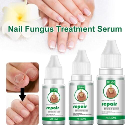 10ml/20ml/30ml Nail Fungus Treatment Serum Fungal Fingernails Toenails Repair Promote New Growth Renew Cracked Nails Solution