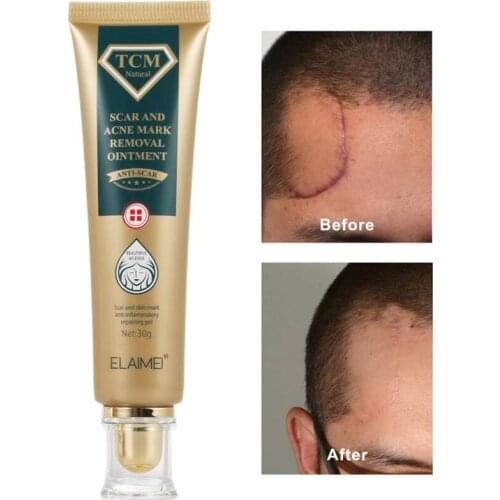 30g Acne Scar Removal Cream Pimples Stretch Marks Face Gel Remove Acne Smoothing Whitening Moisturizing Body Skin Care