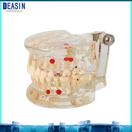 2018 DEASIN Dental Pathological Teeth Implant Model Teaching Teeth Model & Restoration Bridge Tooth Dental Implant Teeth