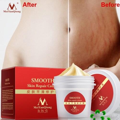 High Smooth Skin Cream For Stretch Marks Scar Removal To Maternity Skin Repair Body Cream Remove Scar Care Postpartum