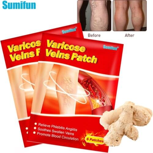 12pcs Sumifun Varicose Veins Plaster Vasculitis Phlebitis Spider Cream Varicosity Angiitis Removal Herbal Medical Plaster K06201
