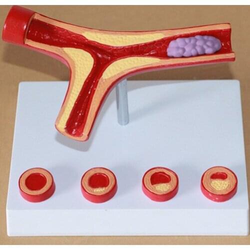 Human Cardiovascular arteriosclerosis model human vascular Thrombosis model