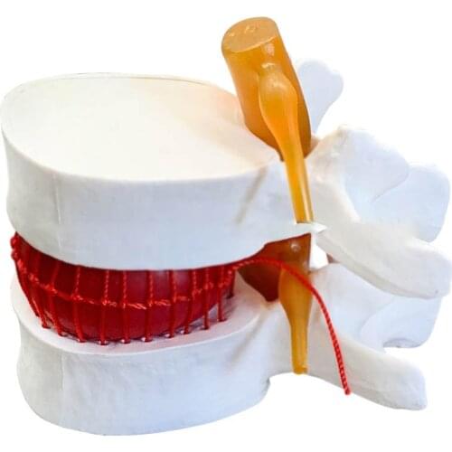 Medical human lumbar disc herniation demonstration model