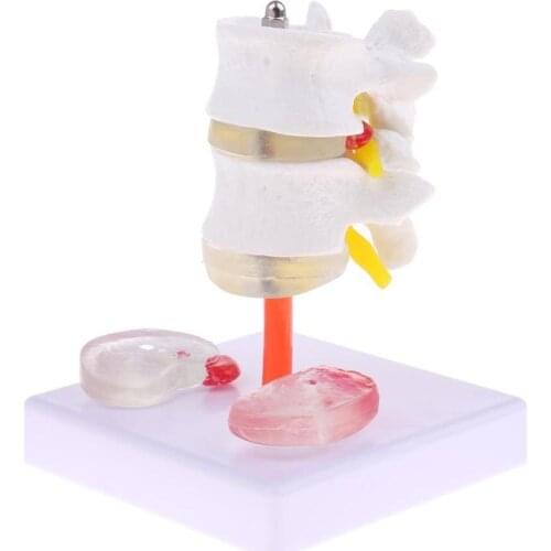 Human 2 Lumbar Vertebra with Diseased Intervertebral Disc Model Medical Skeleton
