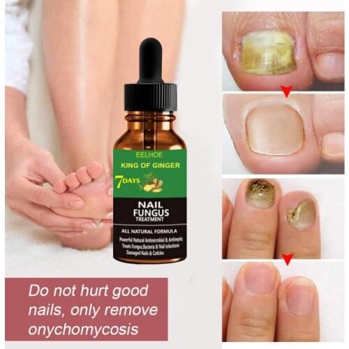 30/50ml ginger foot antifungal essence to remove onychomycosis repair treatment liquid healthy nail care repair liquid