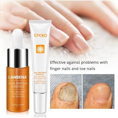 Fungal Nail Treatment Feet Care Serum Whitening Toe Nail Fungus Removal Gel Anti Infection Onychomycosis Nails Repair Essence