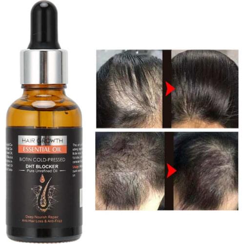 Hair Growth Oil Prevent Hair Loss Thinning Deep Nourish Serum Repair Hair Follicles Anti Frizz 30ML