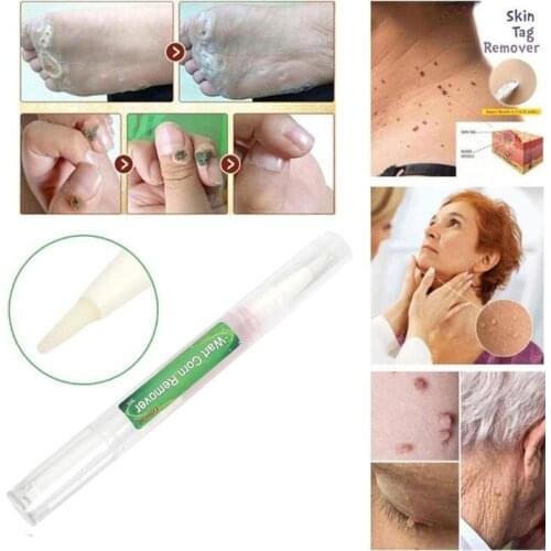 Genital Wart Treatment Papillomas Removal Of Warts Liquid From Skin Tags Removing Against Moles Remover Wart Removal Liuld Tslm2