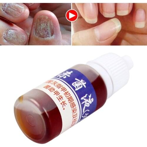 New Hot Nail Treatment Liquid Nourish Antifungal Nails Infection Chinese Herbs Liquid SMR88