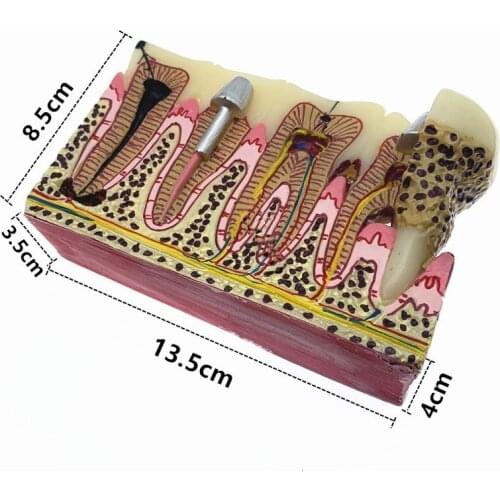 Dental Caries Models Tooth Decay Model For Dental Study Teaching Dental Anatomy Education Teeth Model