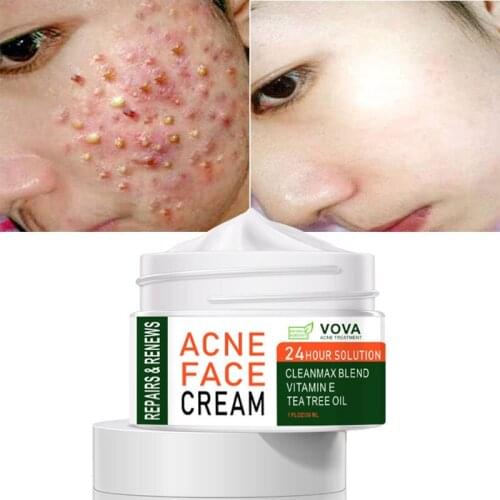 30g Acne Treatment Whitening Cream Blackhead Repair Gel Oil Control Shrink Pore Scars Moisturizing Korea Women Skin Care