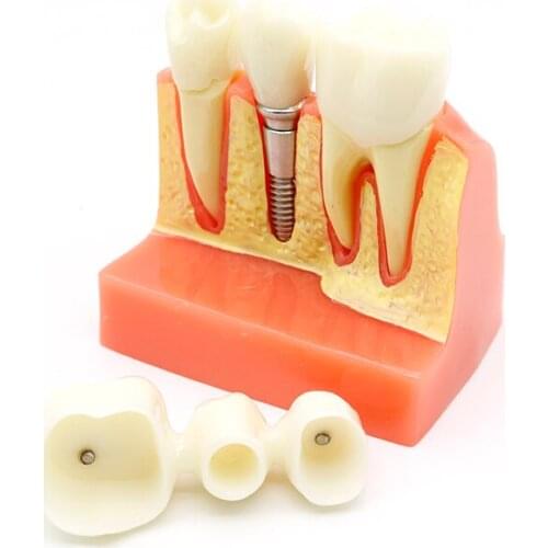 4 Times Dental Implant Analysis Crown Bridge Demonstration Dental Teeth Model Dentist Patience Model
