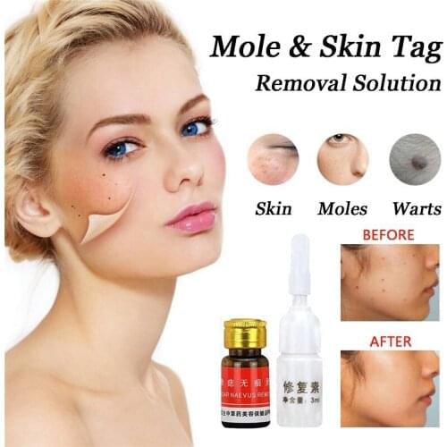 Mole Removal Cream Freckle Removal Cream Face Care Repair Solution Removal Solution Painless 3.0ml Professional Acne Treatment